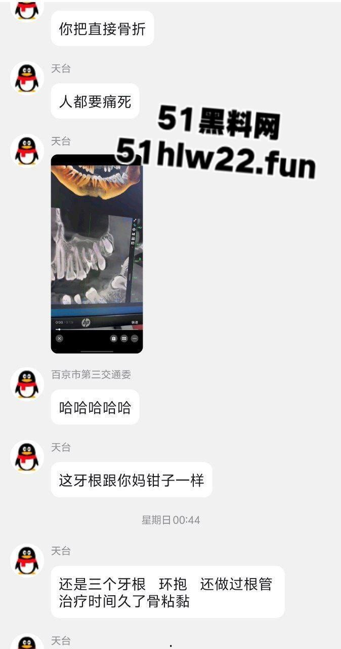 口腔医院逆天操作,客人拔智齿结果医生不分青红皂白直接大力出奇迹, 把上颌骨拔断撤了下来!-3