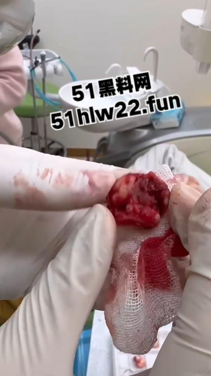 口腔医院逆天操作,客人拔智齿结果医生不分青红皂白直接大力出奇迹, 把上颌骨拔断撤了下来!-6