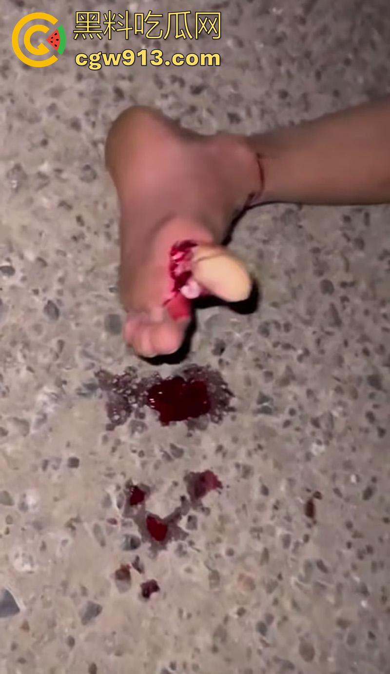 小伙骑摩托车夜晚狂飙,车辆失控撞上对面来车,女友当场飞出死亡,小伙自己全身骨折,看着都疼!-3