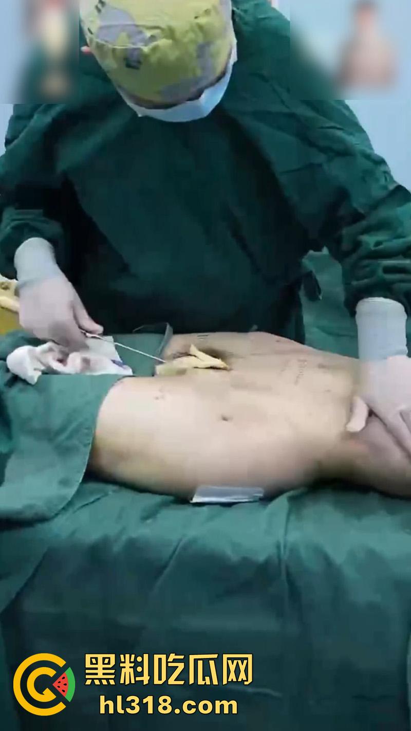 实拍整形医院手术现场，小仙女为了变美，抽脂和填充全过程，虽然看着残忍，但做完后的确是好看呢！-7