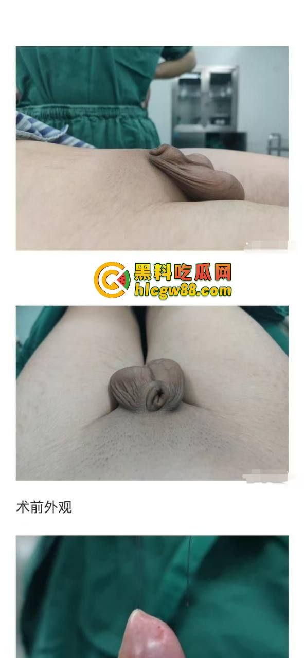 小鸟变大雕换炮计划！阴茎增大手术震撼实测 9CM秒变18CM战神之枪 ，这根真的压不住了！-1