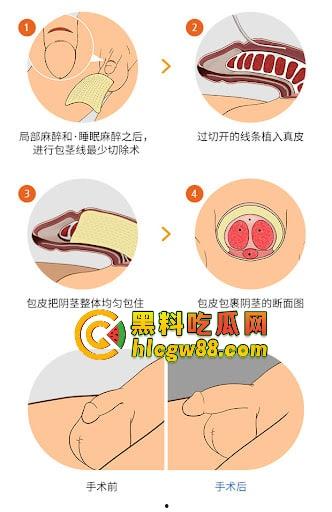 小鸟变大雕换炮计划！阴茎增大手术震撼实测 9CM秒变18CM战神之枪 ，这根真的压不住了！-6