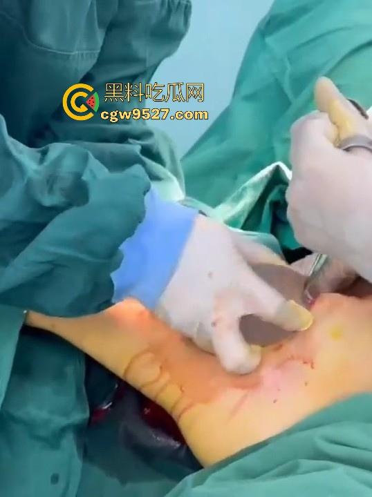 隆胸整形手术现场大曝光！平乳妹秒变巨乳御姐，手术过程一览无遗，女人为变美的代价真大！-5