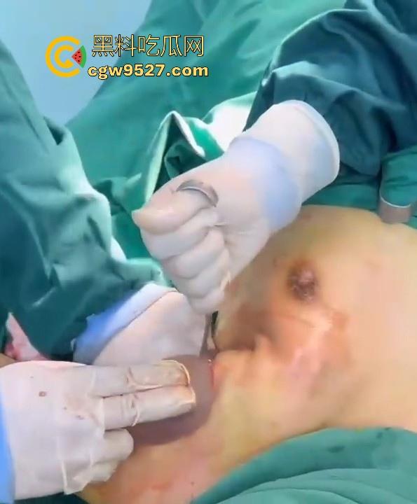隆胸整形手术现场大曝光！平乳妹秒变巨乳御姐，手术过程一览无遗，女人为变美的代价真大！-6