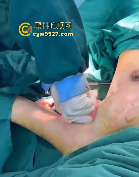 隆胸整形手术现场大曝光！平乳妹秒变巨乳御姐，手术过程一览无遗，女人为变美的代价真大！-8
