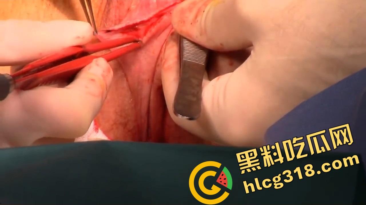 阴唇整形一刀逆天改命，黑木耳变粉鲍鱼，大阴唇手术直接打造一线天馒头逼，姑娘做完直接彩礼翻倍！-11