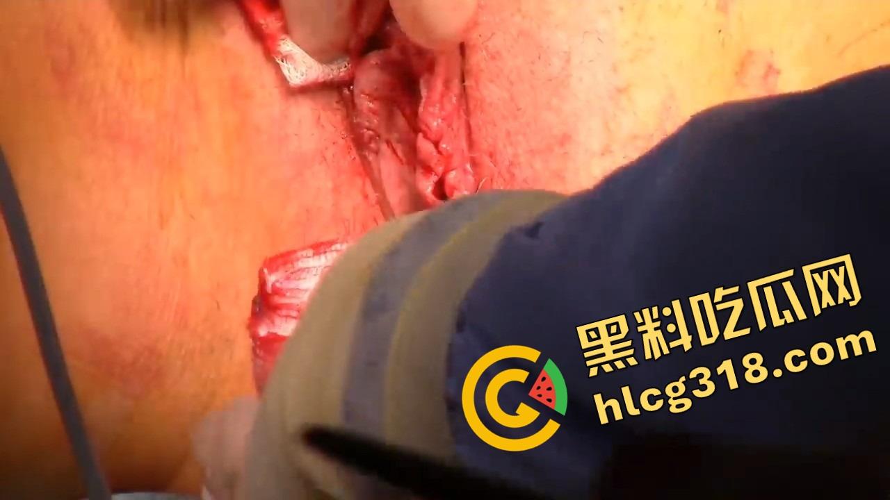 阴唇整形一刀逆天改命，黑木耳变粉鲍鱼，大阴唇手术直接打造一线天馒头逼，姑娘做完直接彩礼翻倍！-13