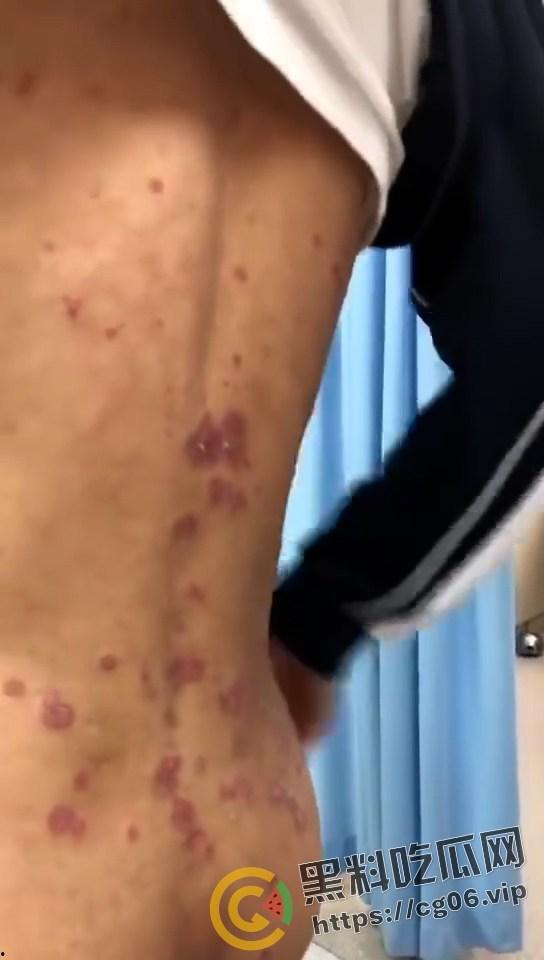 初三学生化身毒王 梅毒三期 艾滋 浑身腐烂 牛子流脓 还说自己没有过性生活 检查现场视频曝光-4