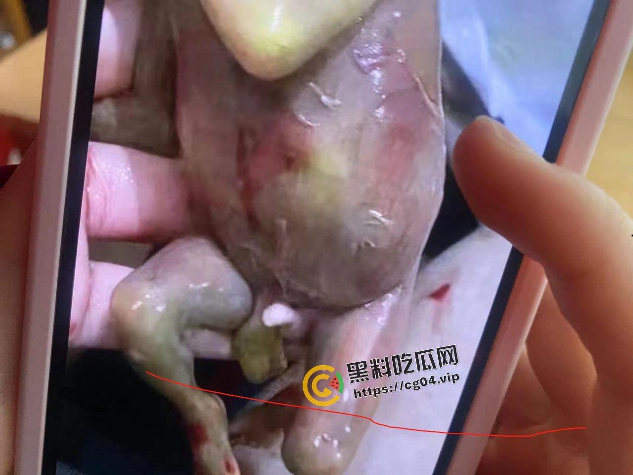 广西商业技师学幼教专业女生厕所早产 四度撕裂  母子双双进ICU-7