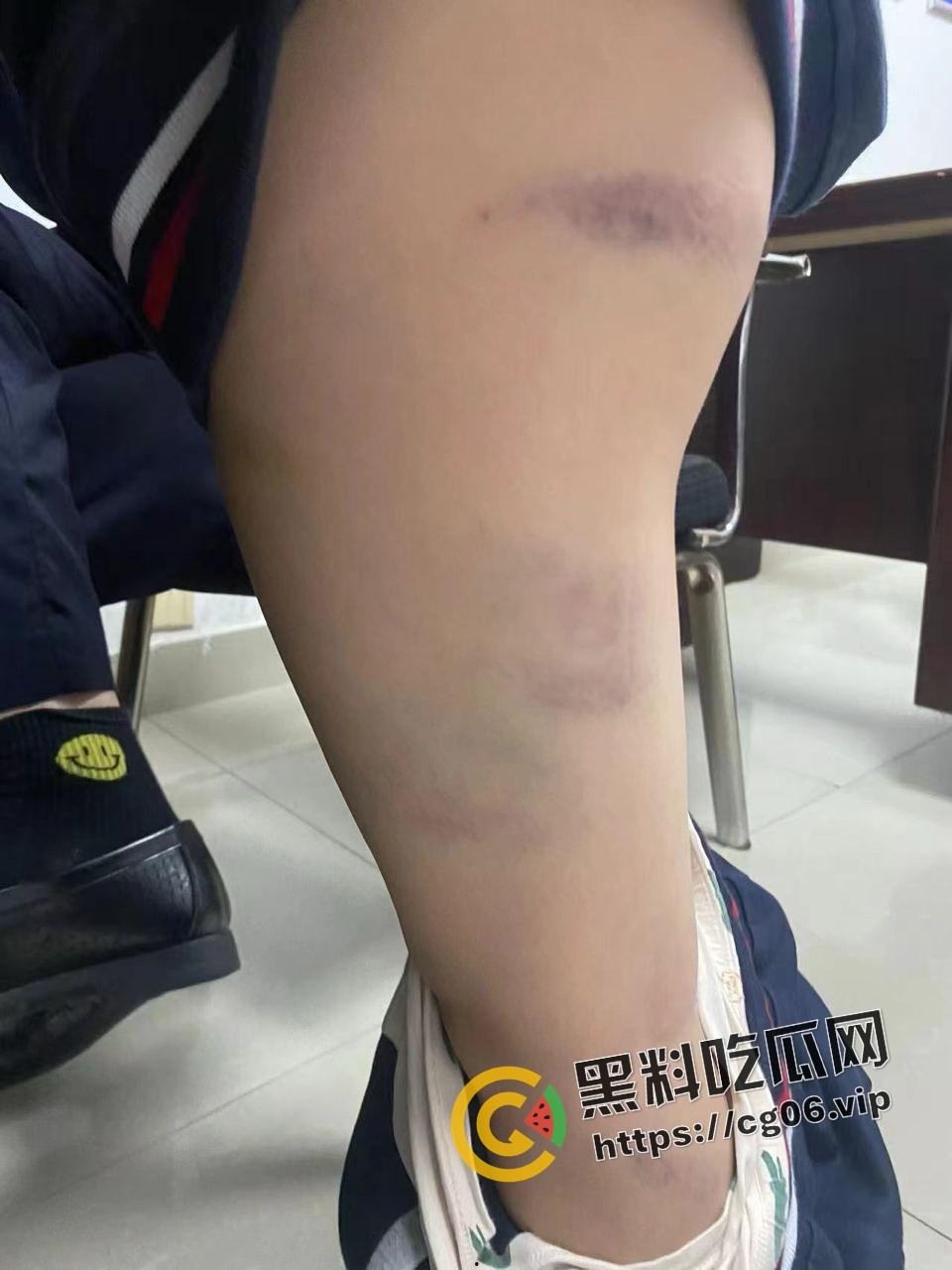 泰州外国语小学老师暴打小学生 全身淤青 家长群内声讨被解散 至今无说法-16