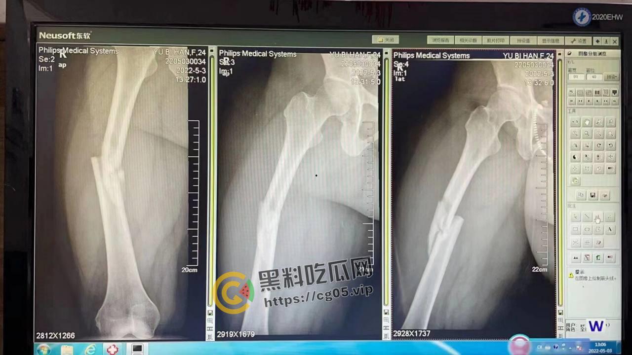 坦克坠楼！三百斤猪猪女孩12楼跳下 车都砸坏了人没死 事后检查仅骨折-8