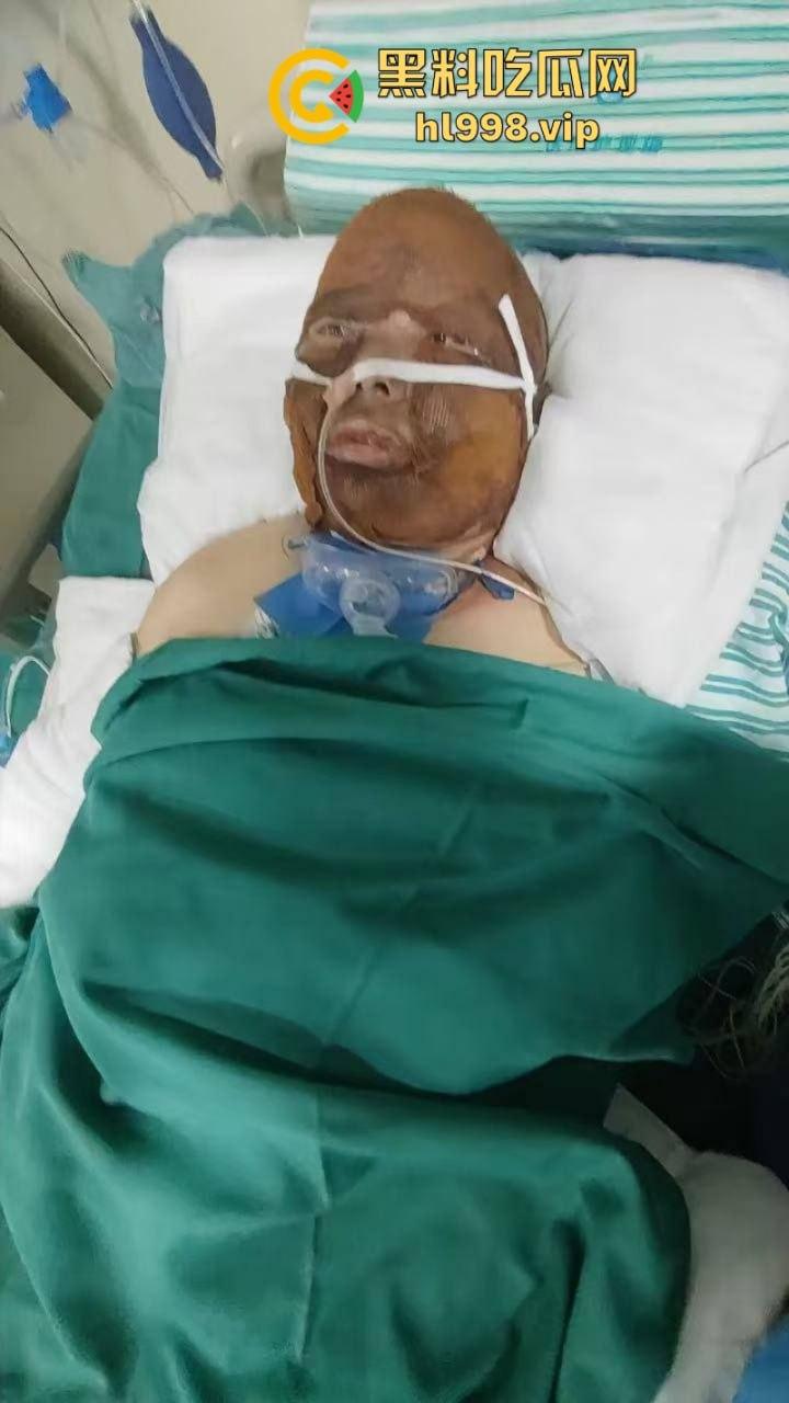 伟大的母亲！浙江诸暨市家中厨房煤气爆炸妻子惨遭烧伤之痛-5