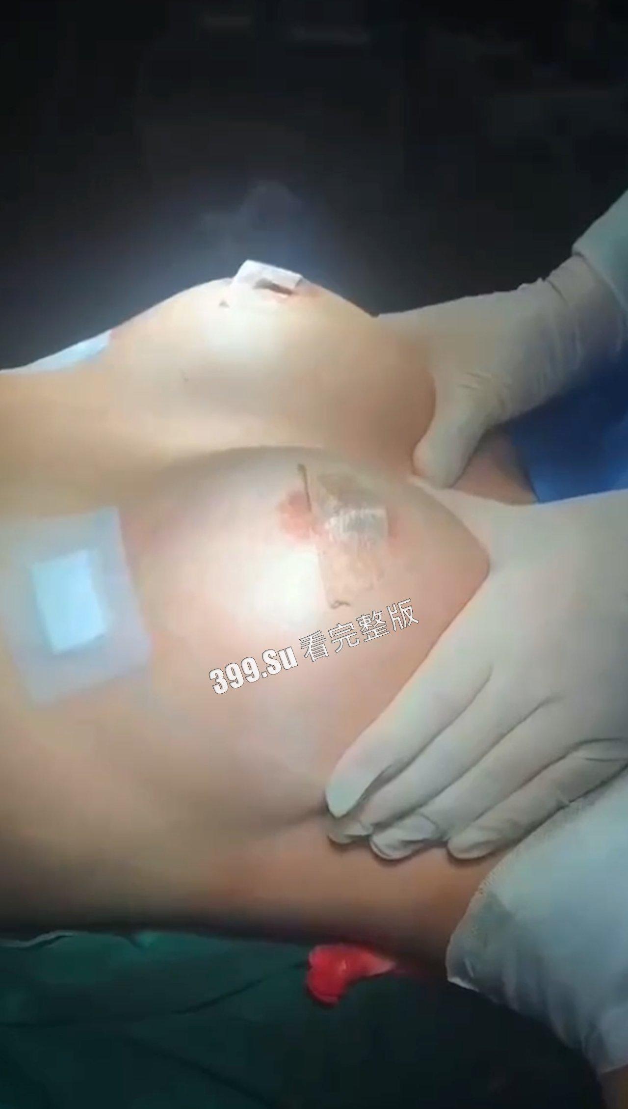 医美整形那些事儿 假的真不了  女人对自己真狠 阴唇黑了就直接切掉 （二）-6